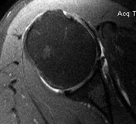 MRI SSC tear minimal retraction